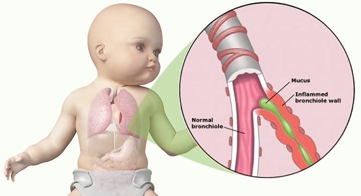 Ilustração Sintomas Bronquiolite